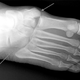 Illustration for article titled What Exactly Is A Lisfranc Injury, Anyway?